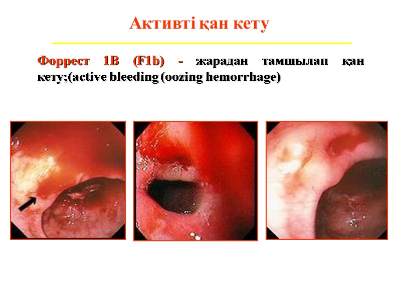 Активті қан кету Форрест 1В (F1b) - жарадан тамшылап қан кету;(active bleeding (oozing hemorrhage)